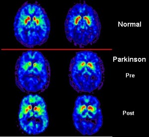 PET_scan_Parkinson's_Disease