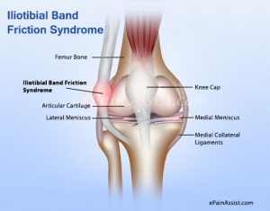 iliotibial-band-friction-syndrome